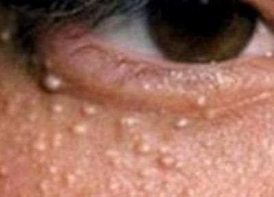 دانه های سفید زیرچشم